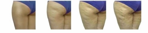 Foto di gradi di cellulite